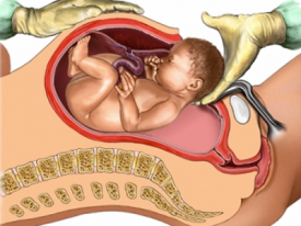 First C Section