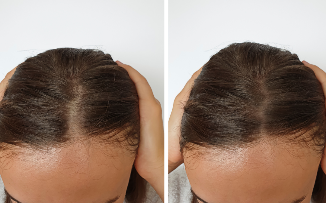 Keranique Hair Regrowth Review